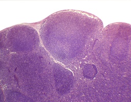 [135007111] Ganglion lymphatique, c.